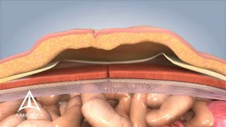 Ventral Hernia Repair  3D Medical Animation [upl. by Gnaig766]