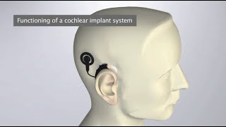 How does a Cochlear Implant work [upl. by Yorgerg]