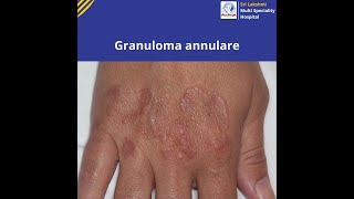 Granuloma annulare   Know Symptoms and Causes of Granuloma annulare  slmsh [upl. by Aiek642]