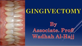 35 Periodontal surgery – 4 Gingivectomy  Dr Wadhah Periodontology lecturesد وضاح الحاج [upl. by Yelehsa]