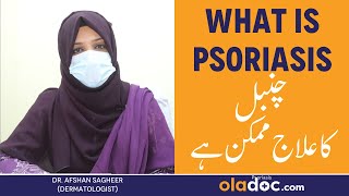 Psoriasis Kya Hai  Psoriasis Treatment In Urdu  Chambal Ki Bimari Ka Ilaj  Psoriasis Removal [upl. by Yonatan]