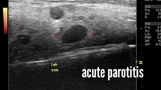 Acute parotitis ultrasound and color Doppler imaging video [upl. by Townie]