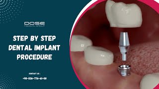 Step by Step Dental Implant Procedure [upl. by Welton]