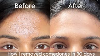 How I removed tiny white bumps from my forehead in 30 days  How to get rid of closed comedones [upl. by Anitnatsnok]