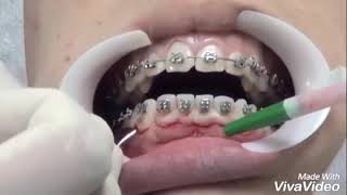 Gingivectomy جراحه قص اللثه [upl. by Gentes]