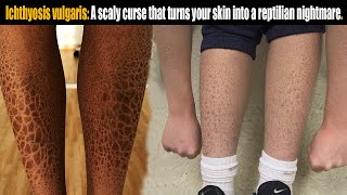 Ichthyosis vulgaris A scaly curse that turns skin into reptilian nightmare [upl. by Aerb]