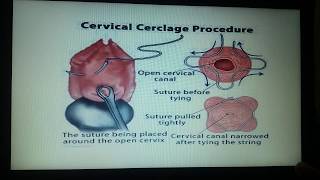 Cervical Insufficiency amp Its Treatment Cervical Cerclage [upl. by Enelyahs]