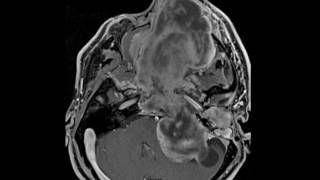 Skull Base Myxoid Sarcoma [upl. by Haggai]