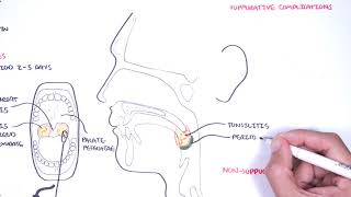 Strep throat streptococcal pharyngitis pathophysciology signs and symptoms diagnosis treatment [upl. by Ruby]