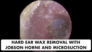 HARD EAR WAX REMOVAL WITH JOBSON HORNE AND MICROSUCTION  Ep 20 [upl. by Doti]