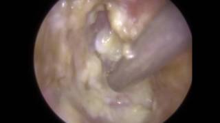 Glue Ear amp ETD in Revealed After Ear Wax Removal  Mr Neel Raithatha THC [upl. by Salahi]