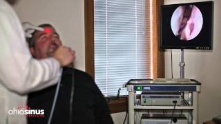 Nasal Endoscopy Informational Video by Ohio Sinus Institute [upl. by Dorice276]