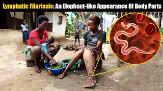 Elephantiasis Or Lymphatic Filariasis An Elephantlike Condition That Afflicts Millions Worldwide [upl. by Bartholemy]