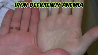 Iron deficiency Anemia IDAanemia signs and symptomsplummer vinson syndrome [upl. by Arden83]