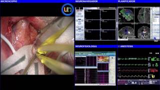 Neurorgsnet Cirugía cavernoma rolándico [upl. by Halyahs]