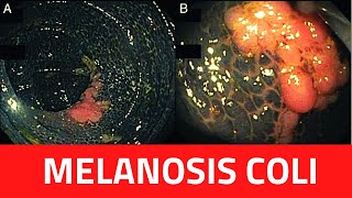 What is Melanosis Coli  Melanosis Coli CausesTreatment LaxativesBiopsyDiagnosis [upl. by Jarred]