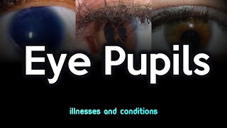 Eye Pupils Illnesses and Conditions [upl. by Ellehc]