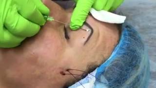 3D PDO COG thread eyebrow lift [upl. by Lapides]