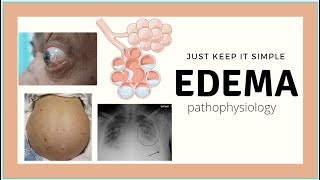 Edema Pathophysiology  Pulmonary edema Ascites physiology basics Med Madness [upl. by Kovar]