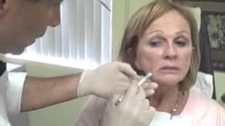 Facial Fillers Treatment with Radiesse and Botox [upl. by Malley161]