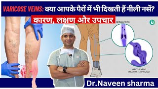 varicose veins ka treatment at home kaise kare [upl. by Netti]