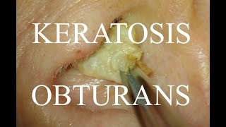 KERATOSIS OBTURANS COMPLETE IMPACTION  4KHD [upl. by Ylram194]