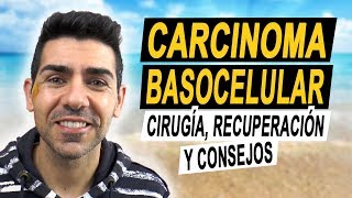 CARCINOMA BASOCELULAR  Operación recuperación y consejos tras tener un carcinoma basal en la cara [upl. by Jillane283]