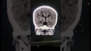 Corpus Callosum Agenesis  Radiology [upl. by Enail]