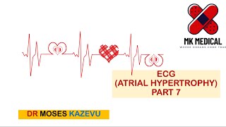 ECG Atrial enlargement Part 7 [upl. by Ycaj410]