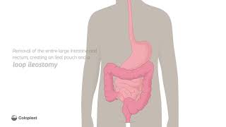 Creation of loop ileostomy by removing large intestine rectum  Ostomy surgery  Coloplast India [upl. by Aicelet]