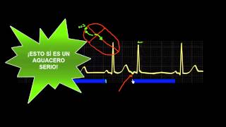 CURSO DE ELECTROCARDIOGRAFIA 47  EXTRASÍSTOLES SUPRAVENTRICULARES [upl. by Jedthus]