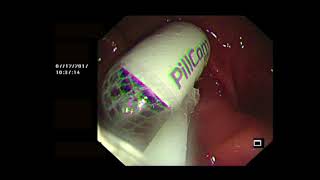 OGD ASSISTED CAPSULE ENDOSCOPY [upl. by Bauer785]