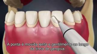 Destartarização Limpeza Dentária [upl. by Ihsorih]