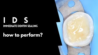 Immediate Dentin sealing  How to perform  Full protocol [upl. by Reeba]