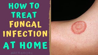 HOW TO TREAT SKIN FUNGAL INFECTION INFECTION AT HOME TINEA RINGWORM REMEDIES HOW TO CURE [upl. by Mercier]