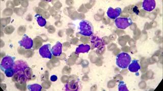 Acute Lymphoblastic Leukemia L3 type [upl. by Auhsaj232]