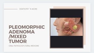 TUMORS PART 5 MIXED TUMORPLEOMORPHIC ADENOMA [upl. by Launce]