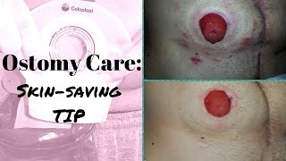 Ostomy Care Tip Saving your skin from abrasion [upl. by Eittik]