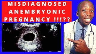 MISDIAGNOSIS OF ANEMBRYONIC PREGNANCY I Misdiagnosed Blighted Ovum Anembryonic Pregnancy I EMPTY SAC [upl. by Aneloc]