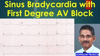 Heart Blocks Anatomy and ECG Reading Animation [upl. by Tarryn]