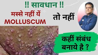 Molluscum एक यौन रोग भी हो सकता है । कारण लक्षण और होम्योपैथी ट्रीटमेंट । [upl. by Evoy]