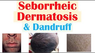 Seborrheic Dermatitis Dandruff and Cradle Cap Causes Risk Factors Symptoms Diagnosis Treatment [upl. by Previdi]