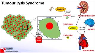 Tumour Lysis Syndrome [upl. by Kacy]