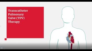 Edwards SAPIEN 3 Transcatheter Pulmonary Valve Replacement Procedure Animation [upl. by Enrobialc]