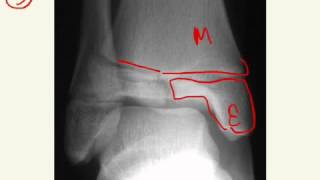 SalterHarris Fractures Answers [upl. by Akin728]