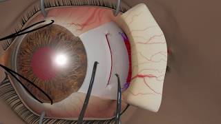 Strabismus surgery Recession [upl. by Rupert]