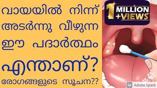 Tonsilstone What is Tonsilolith  എന്താണ് Tonsilstone Explained in malayalam DrAnaghacheleri [upl. by Murielle]