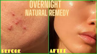 HOW TO GET RID OF ACNE PIMPLES BUMPS ON FACE OVERNIGHT  Simple Home Remedy DIY Lemon Treatment [upl. by Hairom170]