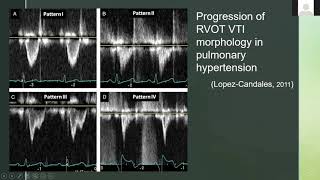 Evaluating RVOT Right Ventricular Outflow Tract With Ultrasound and Doppler [upl. by Sinnoda182]