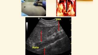 Askep hernia abdominal [upl. by Britton]